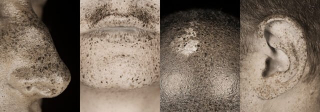 Zones du visage sous lumière UV montrant des taches et risques de mélanomes